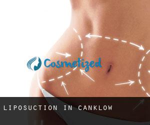Liposuction in Canklow