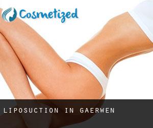 Liposuction in Gaerwen