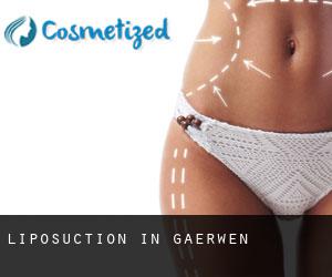 Liposuction in Gaerwen