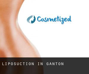 Liposuction in Ganton