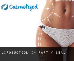 Liposuction in Part-y-Seal