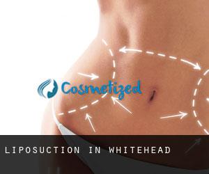 Liposuction in Whitehead